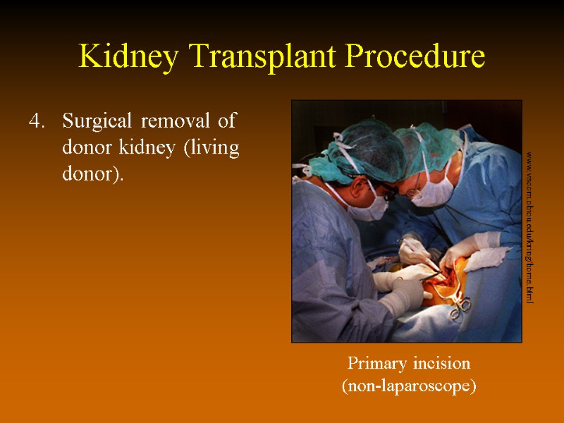 Kidney Transplant Procedure Surgical removal of donor kidney (living donor). Primary incision (non-laparoscope) www.viscom.ohiou.edu/kring/home.html